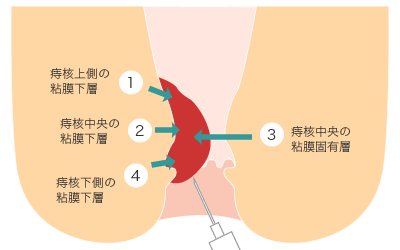 4段階注射療法