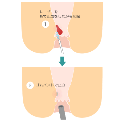 切るイボ痔