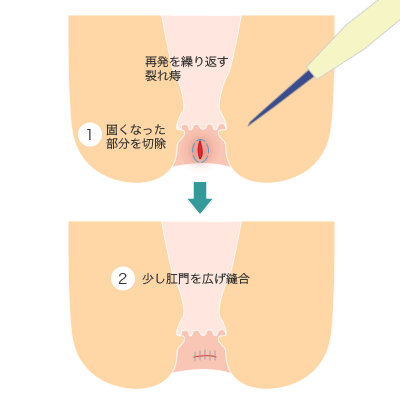切るイボ痔