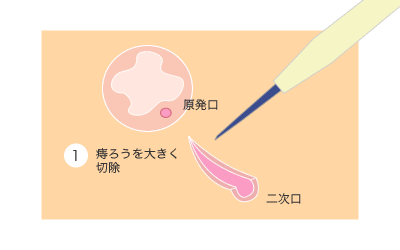 切開開放手術