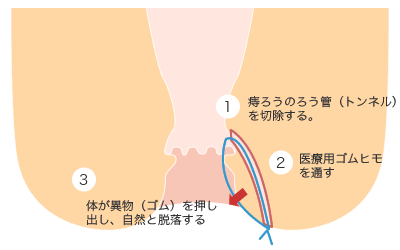 シートン法